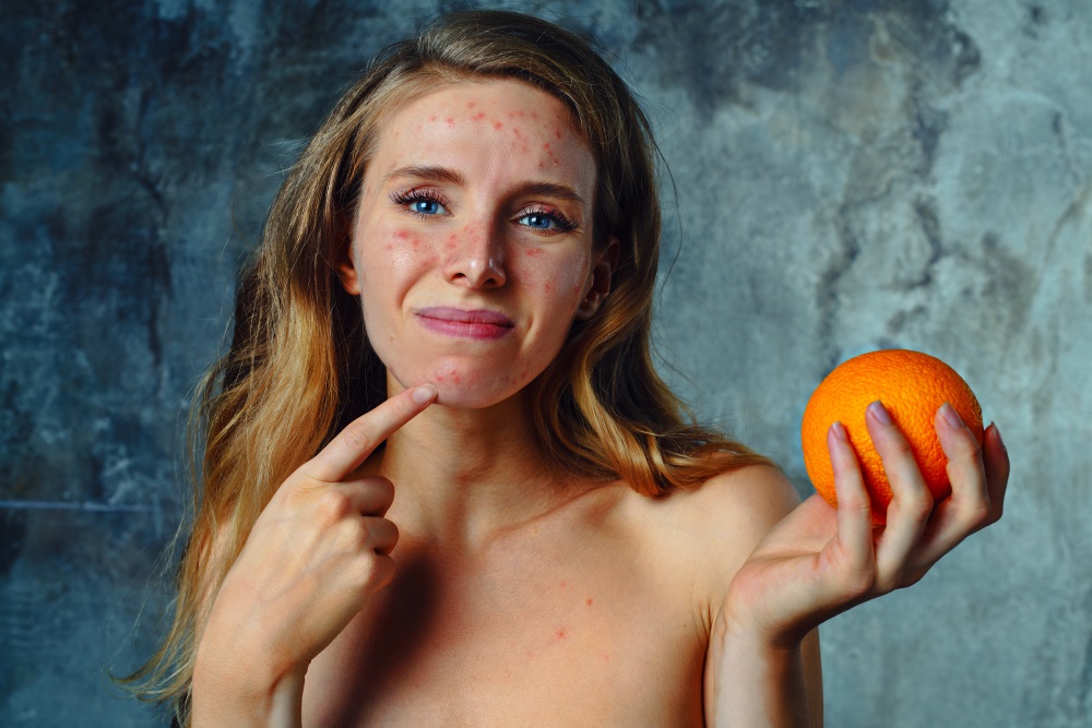 food allergy